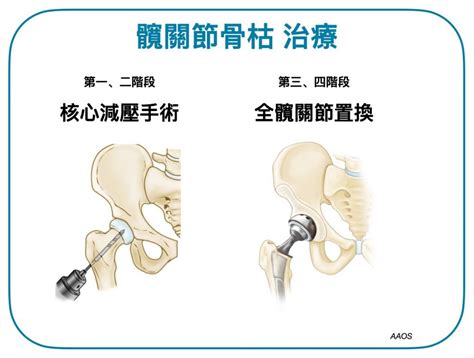 骨枯手術費用|髖關節手術價錢比較！髖關節置換手術需知馬上了解！